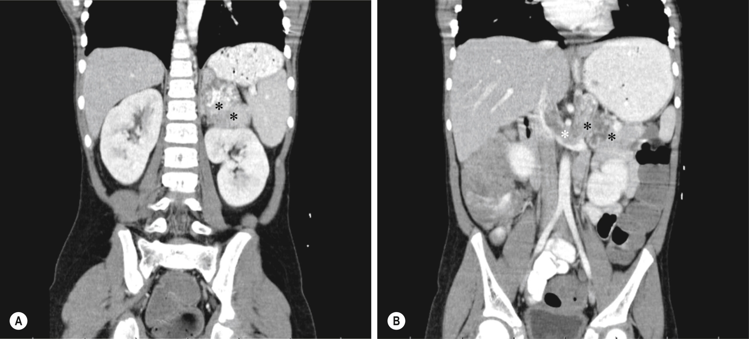 A pair of coronal computed tomographic scans shows a normal adrenal gland on one side and a large, heterogeneous adrenal mass with compression of nearby organs on the other. The pair of coronal computed tomographic scans, labeled A and B, display abdominal sections for adrenal evaluation. Panel A shows a normal adrenal gland visualized above the kidney with well-defined borders and no mass effect. Surrounding abdominal structures, including the kidney, liver, spine, and bowel loops, are intact and unremarkable. Panel B shows a large irregular adrenal mass on the opposite side with heterogeneous density and internal enhancement patterns. The mass causes compression and displacement of adjacent organs including the kidney and bowel.
